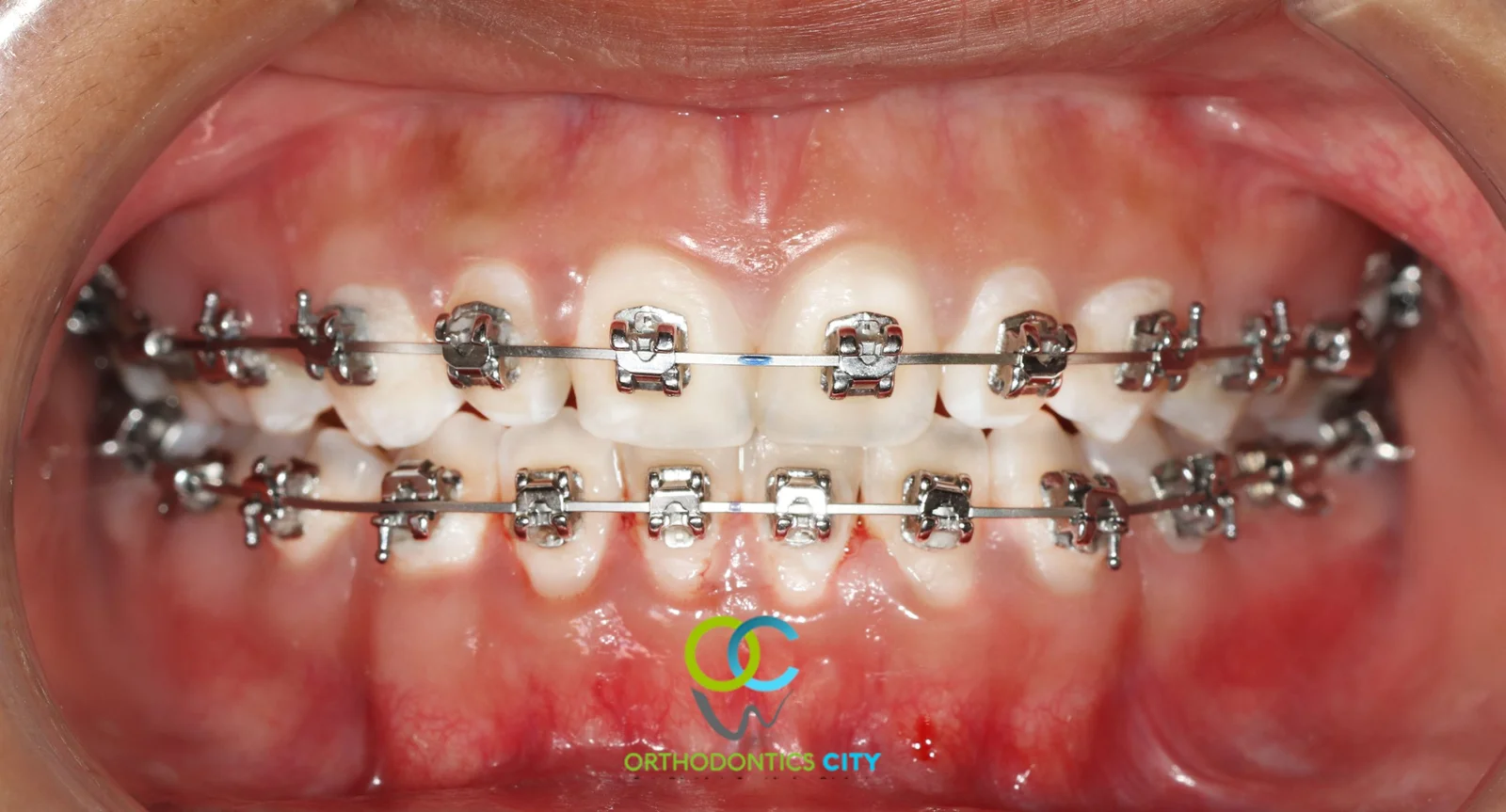 Brackets Autoligados Metálicos