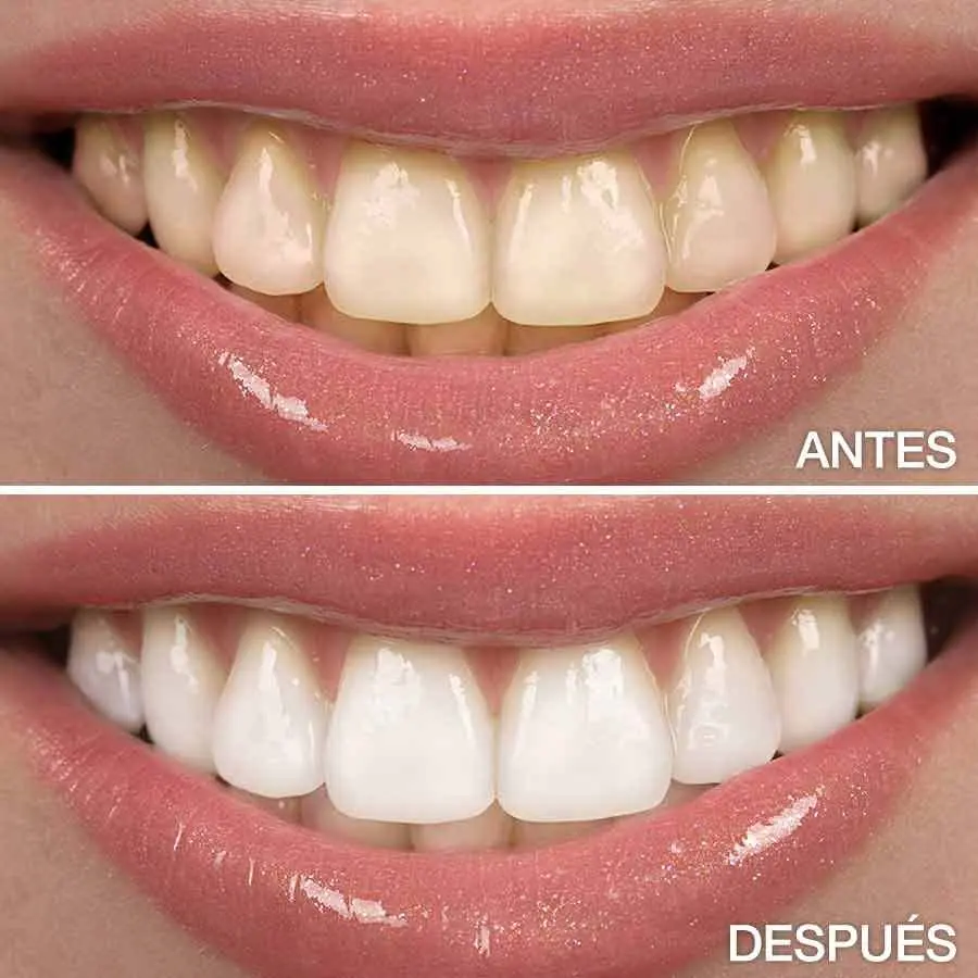 Blanqueamiento Dental
