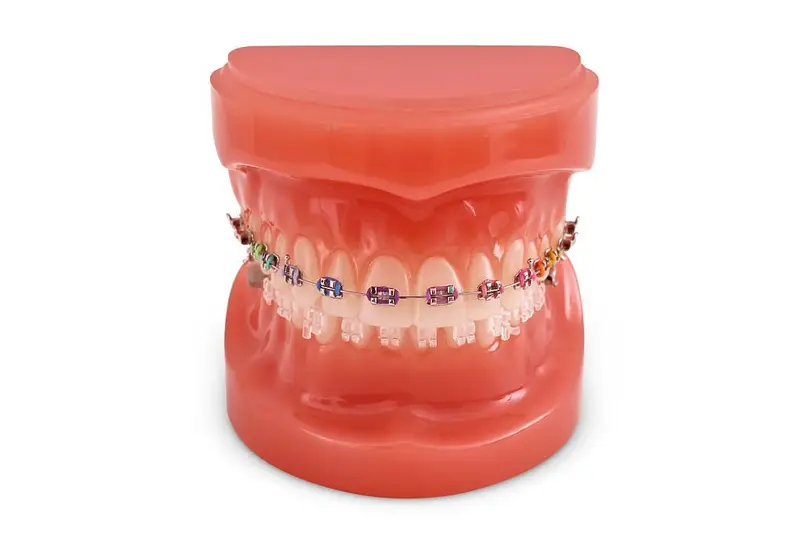 Brackets Tradicionales