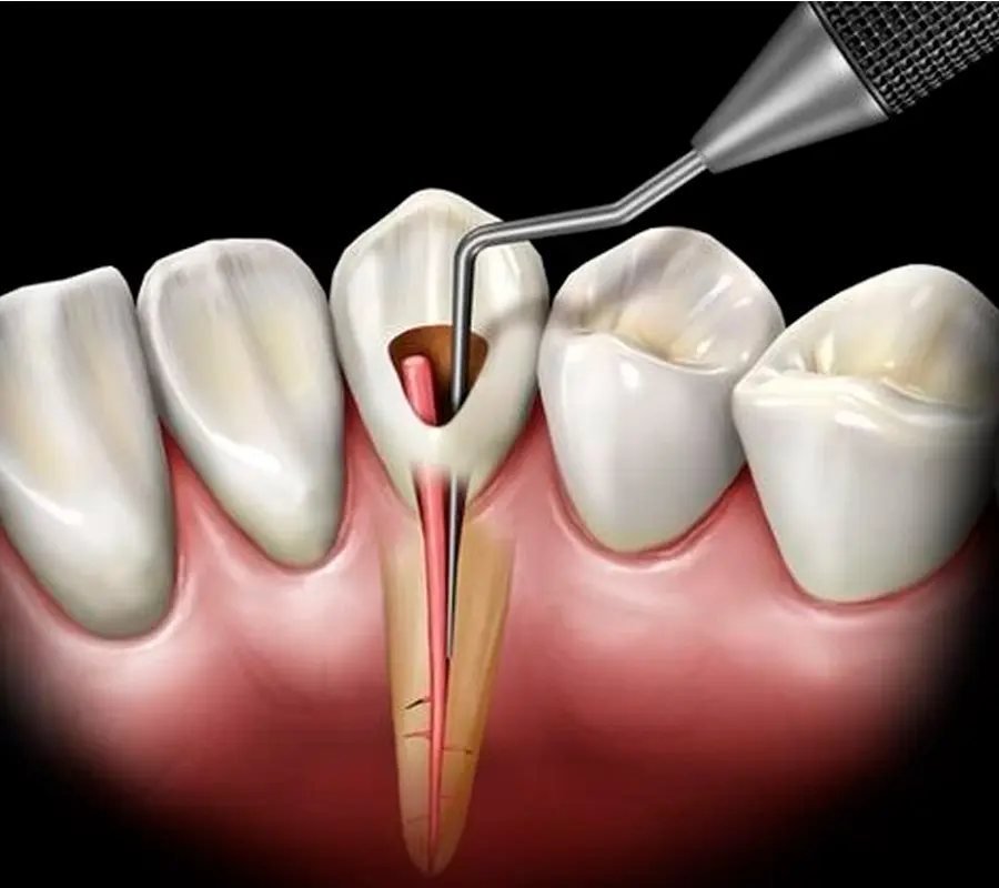 Endodoncia