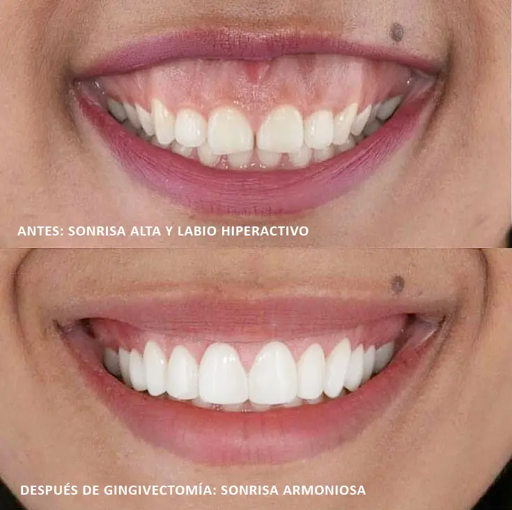 Gingivectomía
