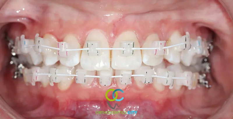 Brackets autoligados estéticos del color del diente en un paciente de la clínica