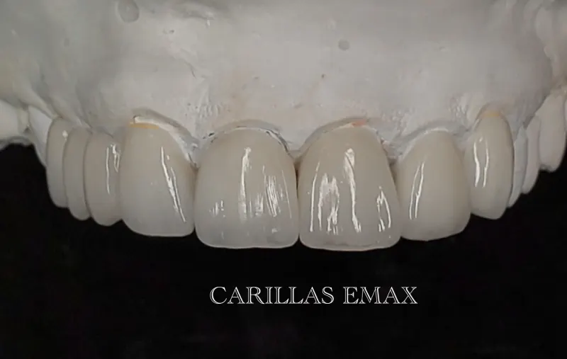 Antes y después: Caso 16: carillas Emax. Carillas Emax elaboradas en el laboratorio, listas para colocarse