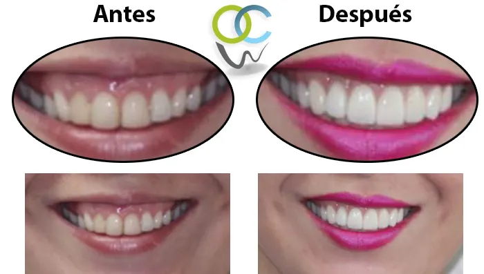 Carillas de porcelana antes y después