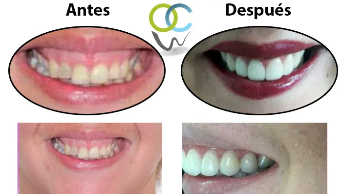 Sonrisa con reducción de encía y carillas e.max, antes y después