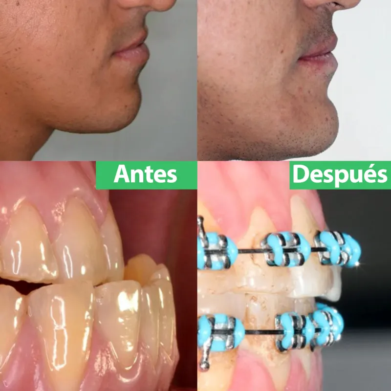 Perfil y mordida de un paciente antes y después de la cirugía ortognática con ortodoncia