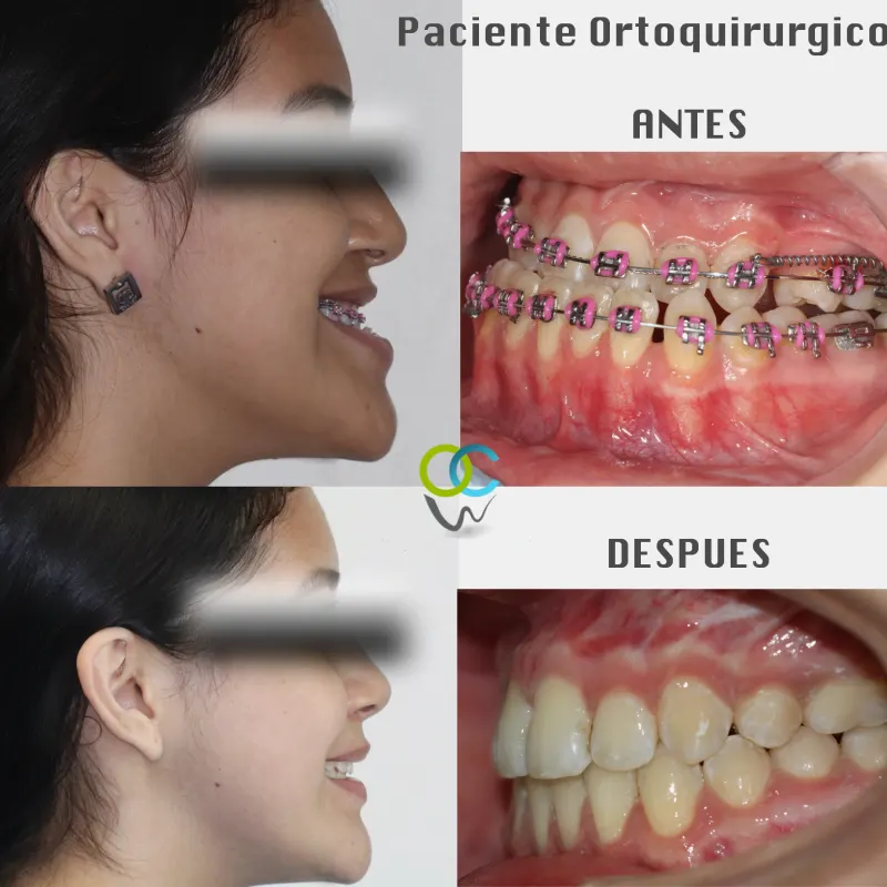 Paciente ortoquirúrgico de Orthodontics City antes y después: mordida y perfil corregidos