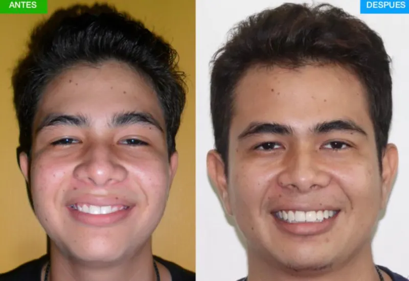 Antes y después: Caso 2: sonrisa alineada. Fotos de frente al inicio y al final del tratamiento de ortodoncia. Su video testimonio está más abajo en esta página