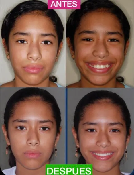 Antes y después: Caso 3: el rostro de frente. La sonrisa de la paciente antes y después de corregir el apiñamiento