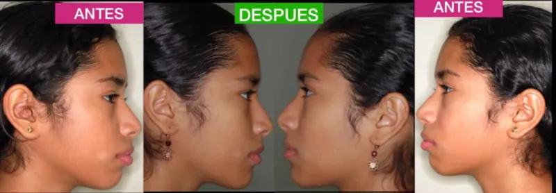 Antes y después: Caso 3: el perfil. Perfil de la paciente antes y después del tratamiento de ortodoncia