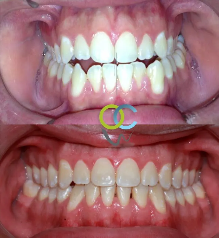 Antes y después: Caso 4: los dientes de frente. Dientes de frente al inicio y al final del tratamiento