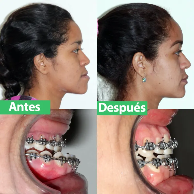 Caso de exceso mandibular tratado con ortodoncia y cirugía: perfil antes y después