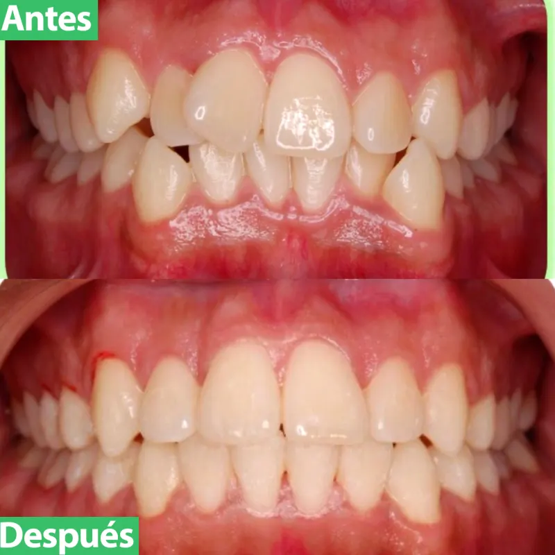 Antes y después: Caso 6: apiñamiento sin extracciones. Apiñamiento marcado superior e inferior corregido sin extraer ningún diente