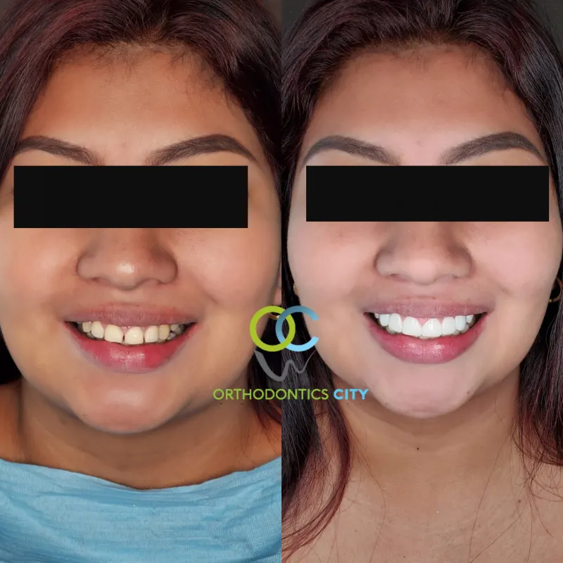Antes y después: Caso 11: cambio de sonrisa con carillas. La paciente quería un cambio en su sonrisa. Colocamos carillas de alta estética