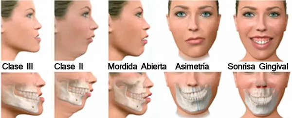 Ilustración de los problemas que corrige la cirugía ortognática: clase III, clase II, mordida abierta, asimetría y sonrisa gingival