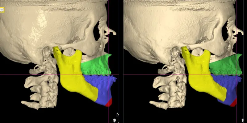 Planificación 3D de una cirugía ortognática sobre la tomografía del cráneo y los maxilares