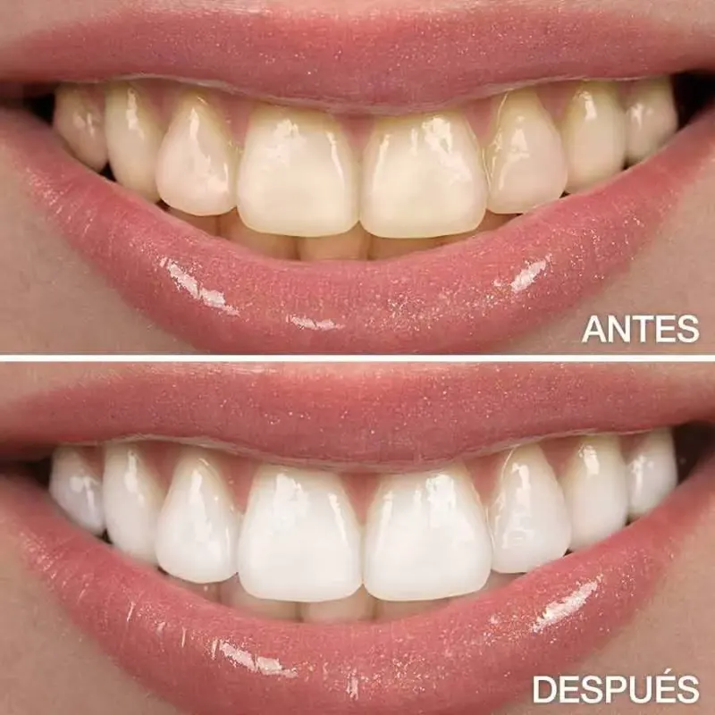 Ilustración de dientes antes y después de un blanqueamiento dental