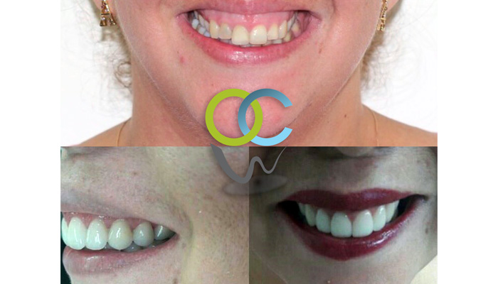 Paciente se realiza procedimiento quirúrgico de reposición labial como alternativa para la resolución de una muy marcada sonrisa gingival. También se realizo protocolo de diseño de sonrisa el cual incluyo  gingivectomia  (cortes de encías) y colocación carillas dentales emax altamente estéticas.